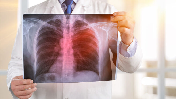 Günde 150 kişi akciğer kanseri teşhisi alıyor