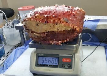 Diyarbakır’da, hastanın bacağından 5 kilo 668 gramlık kitle çıkarıldı