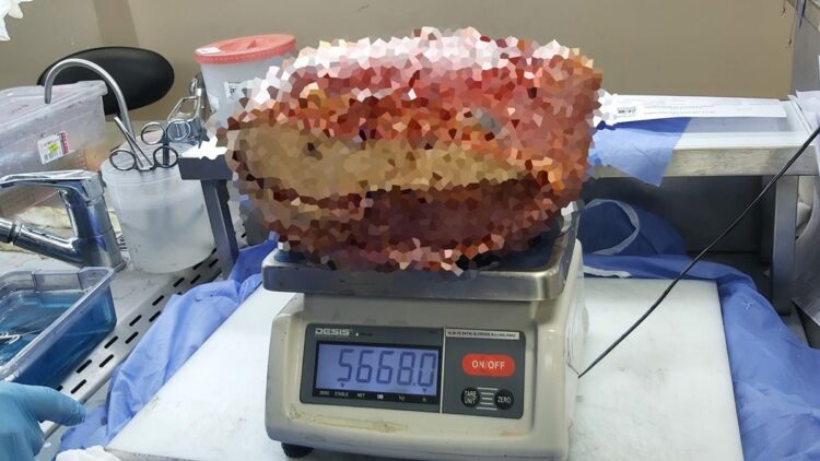 Diyarbakır’da, hastanın bacağından 5 kilo 668 gramlık kitle çıkarıldı