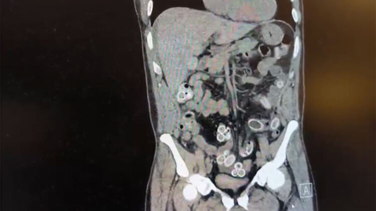 Fas'tan Beşiktaş'a midesinde uyuşturucu getirdi