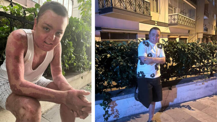 Kuafördeki yangında tüm vücudu yanan 14 yaşındaki Engin'in tedavisi tamamlandı