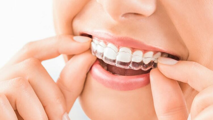 Şeffaf plaklar günlük yaşamı kısıtlamıyor