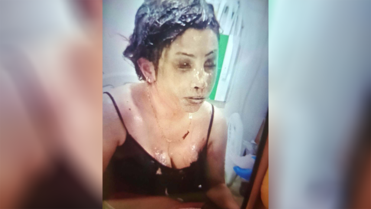 Boşanma aşamasındaki eşinin başından aşağı kezzap döktü