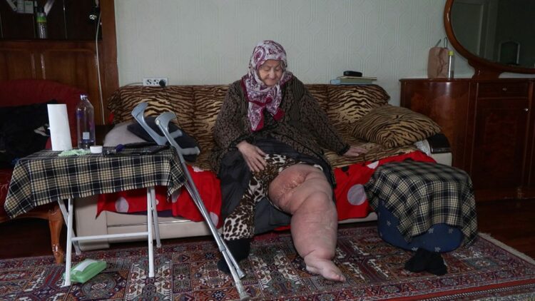 Fil hastalığıyla mücadele ederken oturduğu evin yıkılacağını öğrendi;