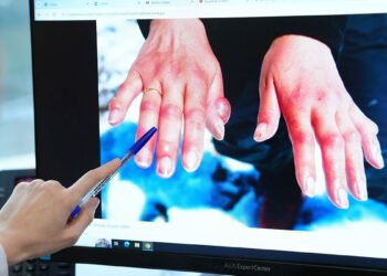 Kış aylarında soğuk ısırığı vakaları artıyor