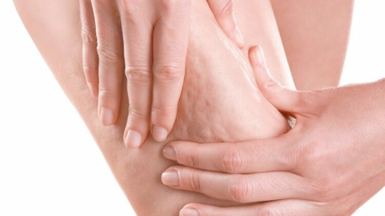 Selülit tedavisinde yeni tıbbi yaklaşım öne çıkıyor