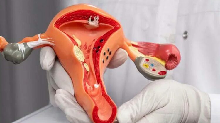 Serviks kanseri hala küresel bir halk sağlığı tehdidi