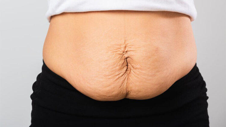 Doğum kilolarınız gitti ama göbeğiniz gitmedi mi?