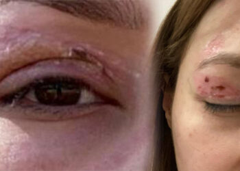 Güzellik salonundaki uygulama sonrası kalıcı hasar iddiası