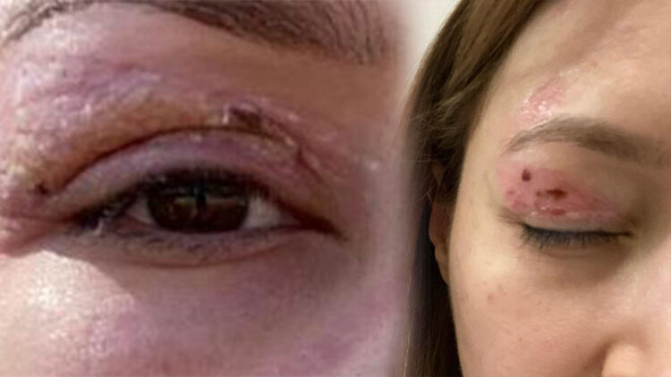 Güzellik salonundaki uygulama sonrası kalıcı hasar iddiası