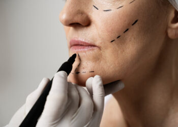 Yağ enjeksiyonu (Lipofilling) kalıcı mı?