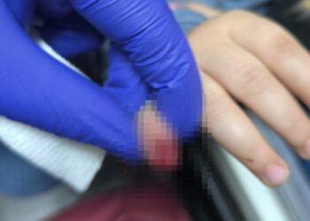 AVM'de yürüyen merdivene eli sıkışan çocuğun parmağı koptu
