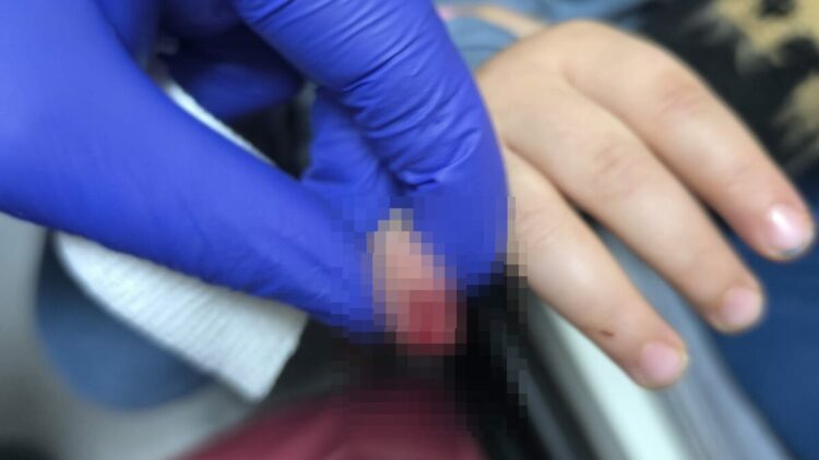 AVM'de yürüyen merdivene eli sıkışan çocuğun parmağı koptu
