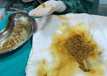 Karın ağrısı şikayetiyle gittiği hastanede safra kesesinden 2 bin 67 taş çıkarıldı
