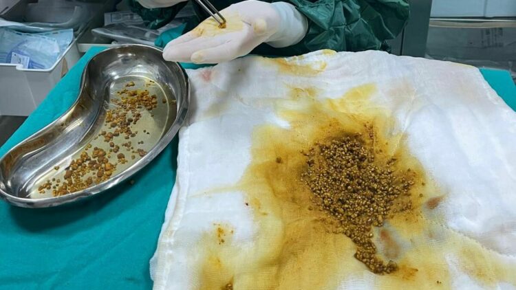 Karın ağrısı şikayetiyle gittiği hastanede safra kesesinden 2 bin 67 taş çıkarıldı