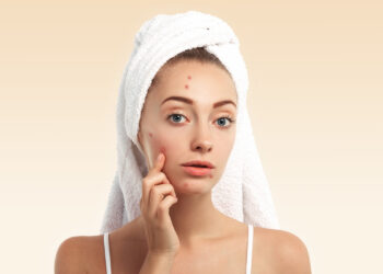 Sivilceler nasıl geçer? Dermatologlardan kesin çözüm önerileri