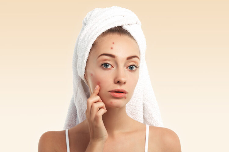 Sivilceler nasıl geçer? Dermatologlardan kesin çözüm önerileri