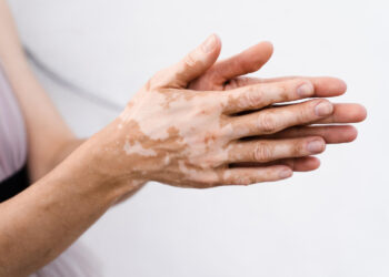 Uzmanından vitiligo uyarısı: Bulaşıcı değil, erken tanı önemli