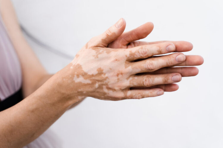 Uzmanından vitiligo uyarısı: Bulaşıcı değil, erken tanı önemli