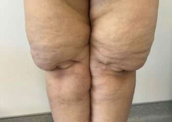 Bacaklardaki simetrik ağrı ve morarma, lipodemin işareti olabilir