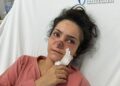 Eşi tarafından burnu ısırılıp koparılan İmran: Canımın acıyla balkondan atlamayı bile düşündüm