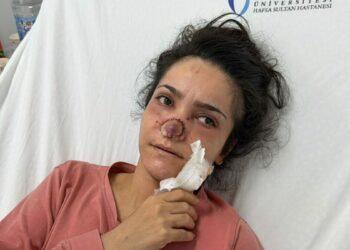 Eşi tarafından burnu ısırılıp koparılan İmran: Canımın acıyla balkondan atlamayı bile düşündüm