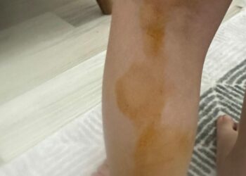 Sokak köpeğinin saldırısına uğrayan Erva yaralandı