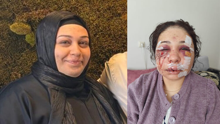Yüzünde 60 dikişle kaldı! Eşini darbeden polis memuru 4 yıl 2 ay hapis cezasıyla tahliye edildi