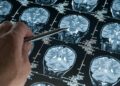 Araştırma: Derin uyku Alzheimer’ı yavaşlatıyor