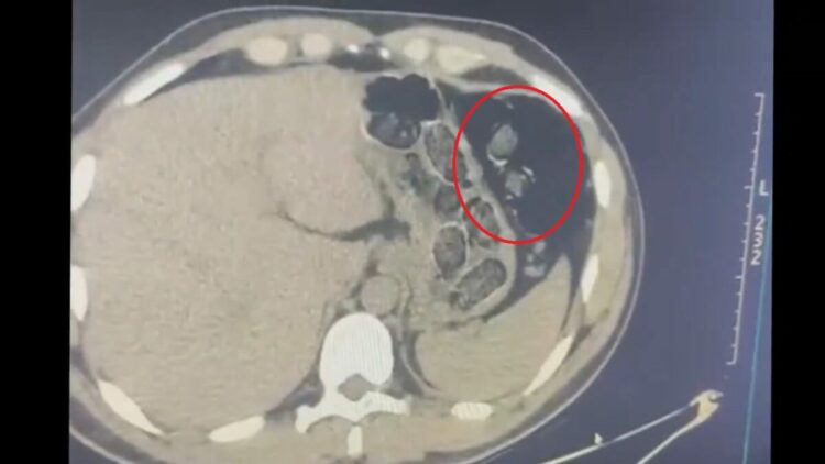 Midelerinden uyuşturucu taşıyan 2 şüpheli tutuklandı