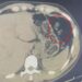 Midelerinden uyuşturucu taşıyan 2 şüpheli tutuklandı