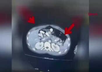2 kilo 675 gram Afyon sakızı yuttuğu tespit edilen 3 şüpheli tutuklandı
