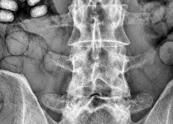 Havalimanında şüpheli 2 yolcunun midelerinden 495 gram metamfetamin çıktı