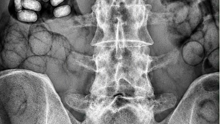 Havalimanında şüpheli 2 yolcunun midelerinden 495 gram metamfetamin çıktı